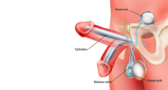 an illustration showcasing a diagram for penile implants
