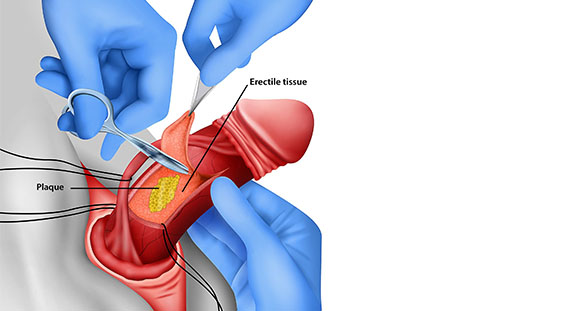 an illustration of the process of a surgical graft as a treatment for Peyronie's Disease