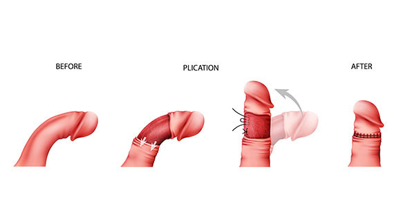 an illustration of the process of penile plication, showing before and after the procedure 
