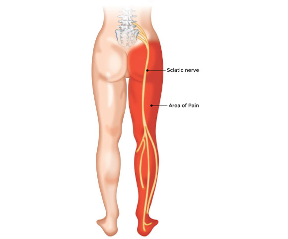 an illustration highlighting the sciatic nerve in the leg, and also highlighting the area of pain in the leg