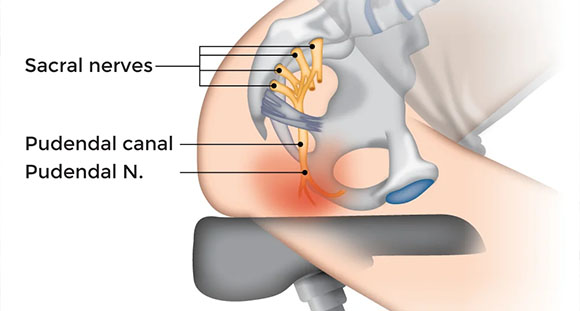 an illustrated diagram highlighting the sacral nerve and how it gets damaged from cycling