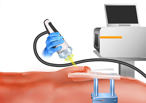 an illustration of a shockwave therapy procedure as a cure for erectile dysfunction