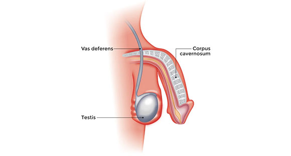 an illustrated diagram of a vasectomy
