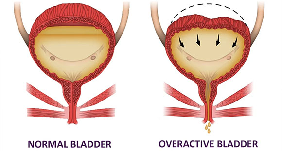 an illustrative diagram comparing a normal bladder with an overactive bladder