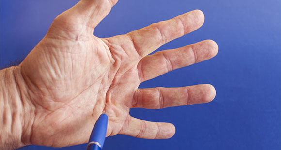 a pen pointing at a hand with Dupuytren's Disease