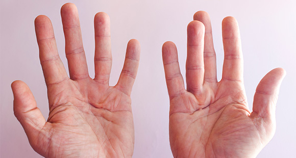 two hands comparing one without Dupuytren's Disease, and one with Dupuytren's Disease