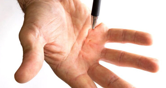 a pen pointing at a man's hand suffering from Dupuytren's Disease