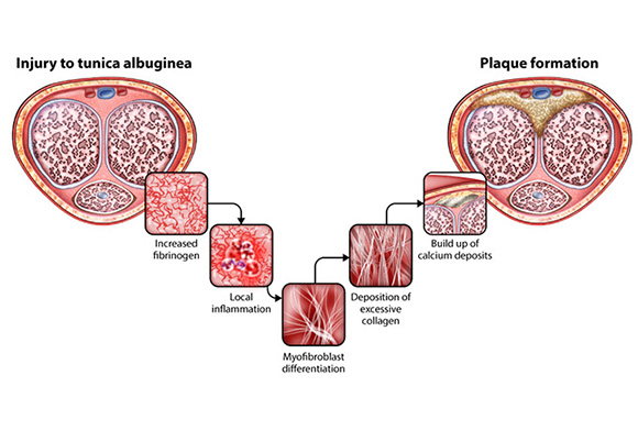 an illustration showing the stages of plaque build-up that causes Peyronie's Disease