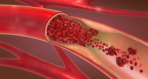 a render of the inside of a blood vessel with the red blood cells struggling to get through an artery 