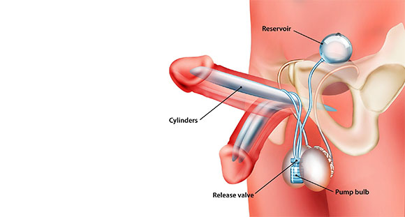 an illustration of how a penile implant works, highlighting each mechanism 