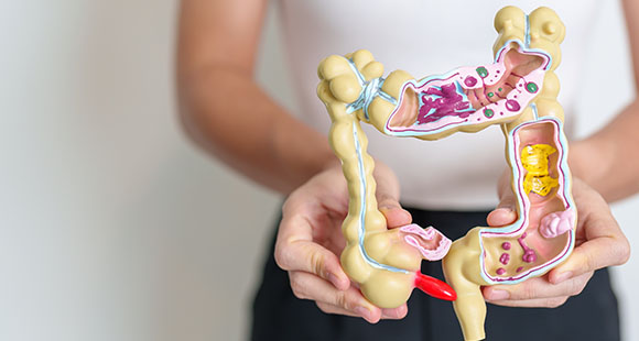 a person holding a model of the large intestines, where IBS tends to form