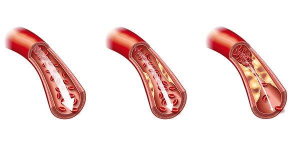 an illustration showing the steps of how cholesterol clogs up arteries 