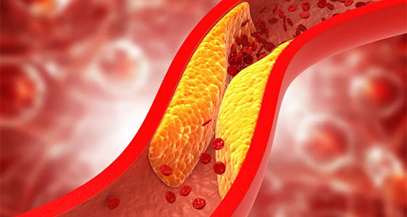 a render showing the narrowing and hardening of a blood vessel from atherosclerosis 