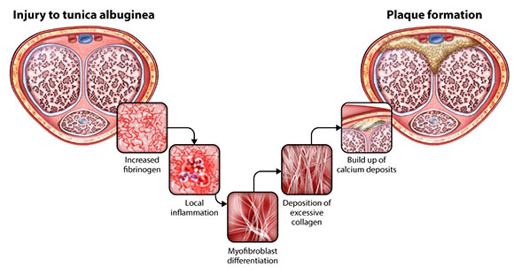 a diagram showing how plaque formation accumulates that caused Peyronie's Disease