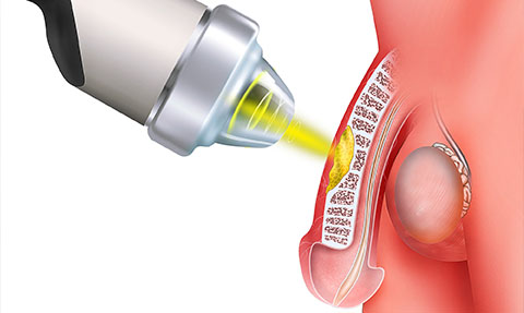 an illustration of shockwave therapy being administered to a penis to aid with the treatment of Peyronie's Disease
