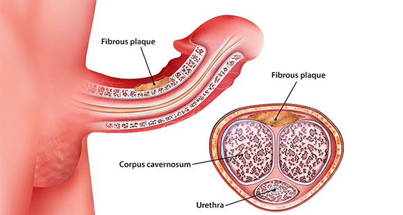 an illustration of a diagram showcasing what Peyronie's Disease is, highlighting the fibrous plaque that causes it