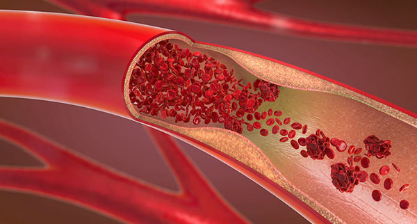 an illustration showing red blood cells flowing through a narrowed artery - which can be a factor in PE