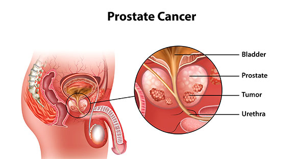 an illustration highlighting prostate cancer and what it looks like on the prostate