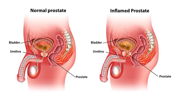 an illustration comparing and contrasting a normal prostate versus an inflamed prostate
