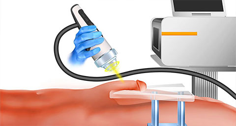 an illustration of a shockwave therapy as a non-surgical alternative to penile implants