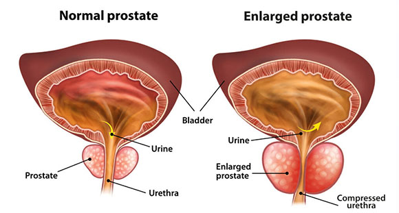 an illustration highlighting a normal prostate versus an enlarged prostate