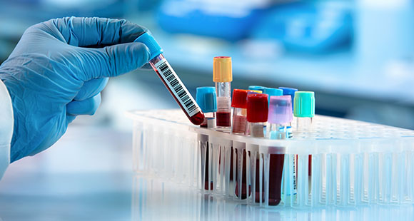 a doctor with blue gloves holding up a vial of blood from a blood test