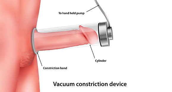 an illustration of a penile pump, and how it can aid with treatments for men's sexual health issues