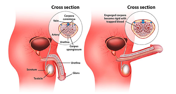 an illustration comparing a normal penis versus a penis with hard flaccid syndrome