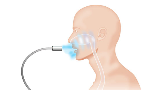 an illustration of a person undergoing a NanoVi® Exo treatment for Peyronie's Disease