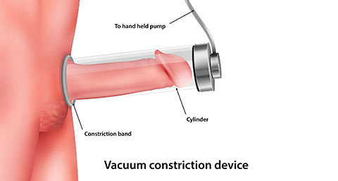 an illustration highlighting how a penile pump works as a treatment for Peyronie's Disease