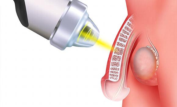 an illustration of a close-up showcasing what shockwave therapy targets in the penis