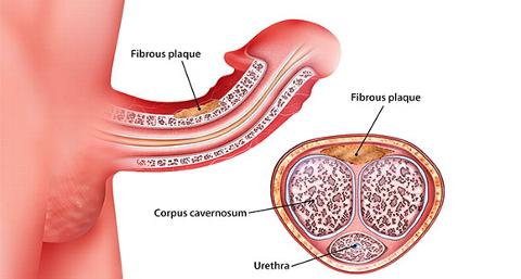 an illustration of Peyronie's Disease, highlighting the fibrous plaque that causes it